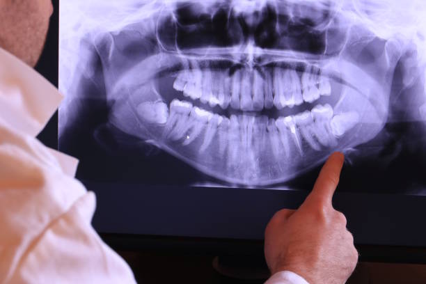 Best Emergency Wisdom Tooth Extraction in Mills, WY