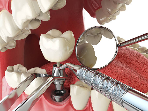 Best Knocked-Out Tooth (Avulsed Tooth) Treatment in Mills, WY